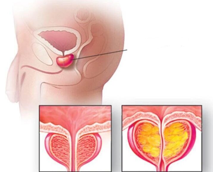 Lokalizacja gruczołu krokowego, prostata prawidłowa i powiększona w przewlekłym zapaleniu gruczołu krokowego