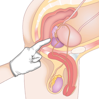 Określanie stanu prostaty metodą palpacyjną w celu rozpoznania zapalenia gruczołu krokowego