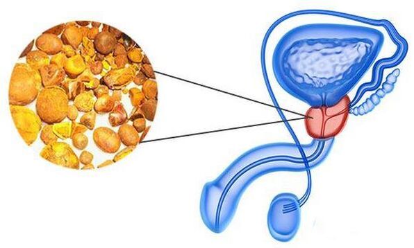 Problemy z zapaleniem prostaty