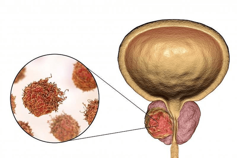 jak wygląda uszkodzenie prostaty
