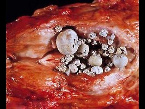 Obliczeniowe zapalenie prostaty