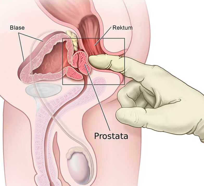 masaż prostaty na zapalenie gruczołu krokowego