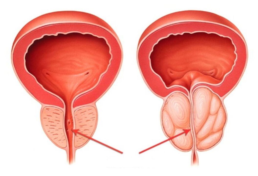 zdrowa i zapalona prostata z zapaleniem prostaty
